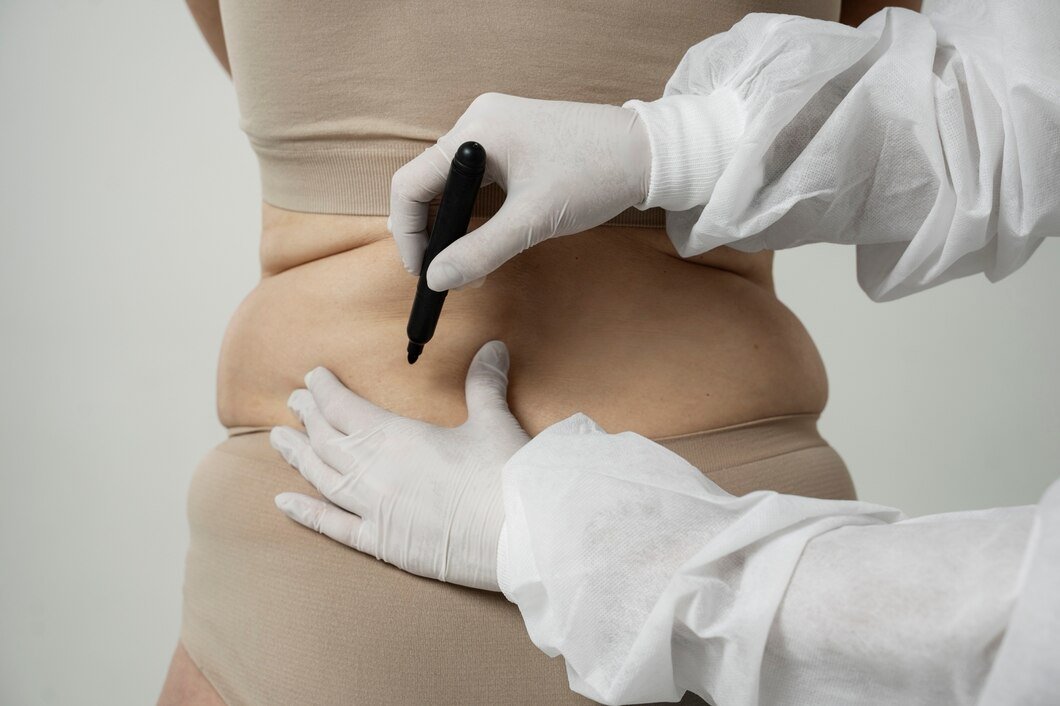 non-surgical and non-invasive procedure for the removal of belly fat