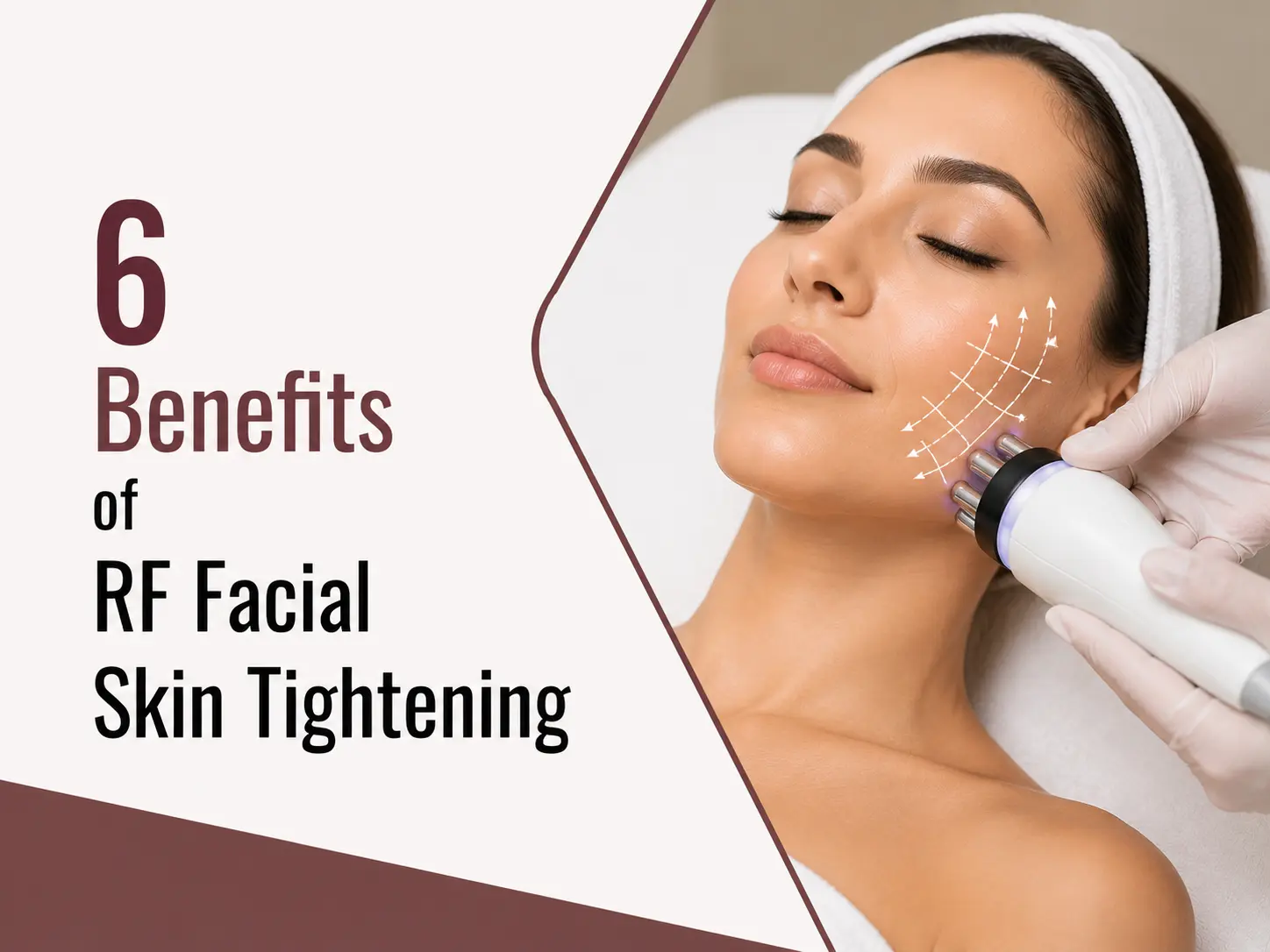 Benefits of RF Facial Skin Tightening
